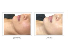 チョンダムビューティー(chondam beauty)/水光ピールによる肌トーンアップ