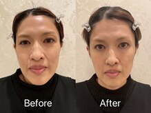 ビューティーベリッシモ(Beauty Bellissimo)/EMS顔筋トレーニング