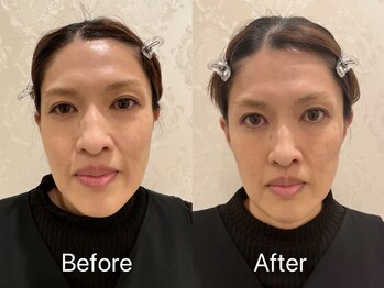 ビューティーベリッシモ(Beauty Bellissimo)/EMS顔筋トレーニング