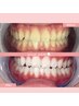 【医療提携ジェル付】6～7トーンUP◎ハイパワーホワイトニング45分照射