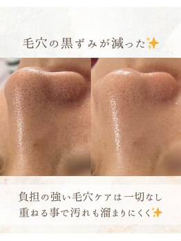 ミリアージュ(Miliage)/before / after