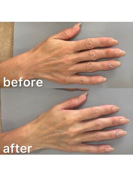 オテテ アイアンドハンド(otete eye&hand)/ハンドケアビフォーアフター