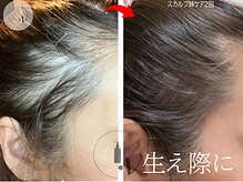 LUNEA/《症例》育毛促進