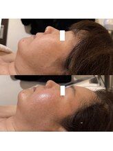 月ノユメ(tsukinoyume)/上ビフォー　下アフター