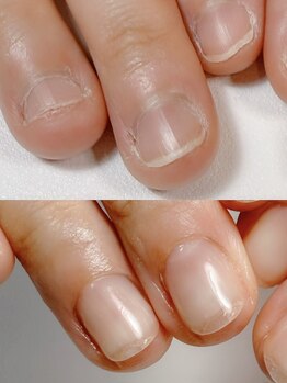 あしぁか 銀座の写真/【爪の救急箱】巻き爪・肥厚爪から手の深爪まで！専門技術で長年の爪の悩みを解消し、自信の持てる手足へ。