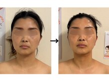 ドクターエイジレス(DR.AGELESS)/バイオセルショットコース1回