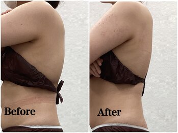 ルピア(L'pur)/背中のビフォーアフター★