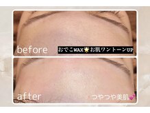 透明感UP！【おでこＷＡＸ】おでこの産毛と古い角質をとり生まれたてのツヤツヤおでこ◎