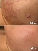 メナードフェイシャルサロン 片町店/ニキビ肌荒れ根本ケア