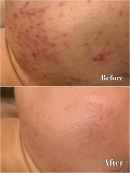 メナードフェイシャルサロン 片町店/ニキビ肌荒れ根本ケア