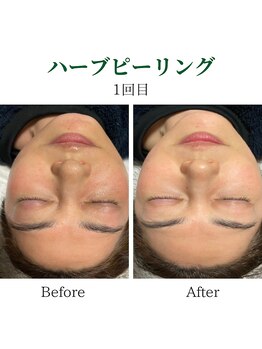 エース(ACE.)/ハーブピーリング☆肌質改善