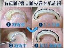 ひかわ整骨院 熊本巻き爪センター/母趾巻き爪施術　１ヶ月後の経過