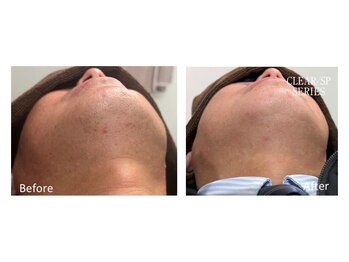 スタンド(STAND)/髭脱毛