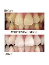 ホワイトニングショップ 安城店/【BeforeAfter】