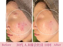 アメリイ 百合ヶ丘 新百合ヶ丘(Amerii)/ハーブピーリング/ニキビ/毛穴