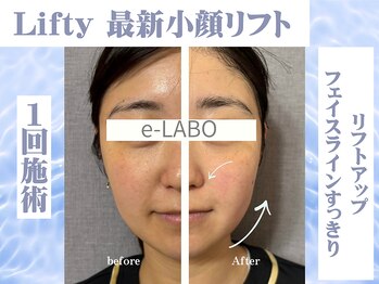 イーラボ 池袋店(e-LABO)/フェイスラインすっきり小顔♪