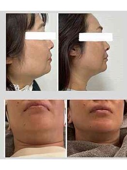 リタプレイス 琴似(LITAPLACE)の写真/大人気！針を使わない脂肪分解ケア！お顔初回22,000円→8,000円！