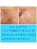 しみケア★ポロッと薄くなる♪５分間当て放題