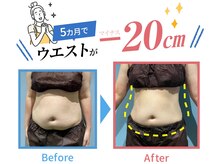 脂肪冷却で脂肪にさよなら！リバウンド知らずの新感覚ダイエット