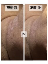 プレシャスサロン(precious salon)/肌荒れ