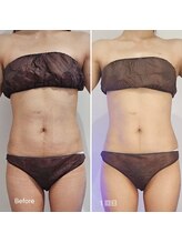 ラクト サロン(RAKT salon)/脂肪冷却４カップ 脇腹 上下腹部