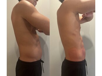 フラットベリー 恵比寿(Flat BELLY)/脂肪冷却4カップ