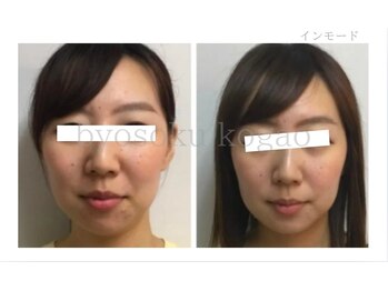 メディカルエステ 新宿南口店/*インモード症例写真*