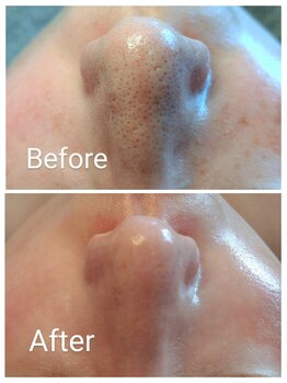 クラリス(Clarice)/鼻の毛穴、黒いポツポツを綺麗に