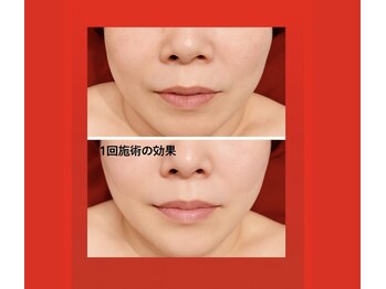 ラシクビューティールーム/食いしばり/小顔/リフトアップ