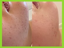 ヴィオール 名古屋栄店(VIOR)/ハーブピーリング