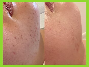 ヴィオール 名古屋栄店(VIOR)/ハーブピーリング