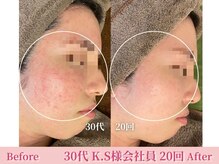 アメリイ 百合ヶ丘 新百合ヶ丘(Amerii)/ハーブピーリング/ニキビ/毛穴