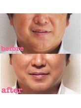 アキ/初回お試しbefore＆after
