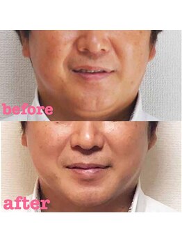 アキ/初回お試しbefore&after