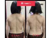 リコメンス(Recommence)/背面矯正