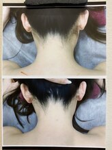美容脱毛専門サロン エピラージュ 新宿店(Epilage)/痛み肌が弱くても脱毛可能