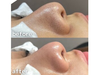 サージュクロレ 松戸店(sage colorer)/人気No1！毛穴クリーンケア