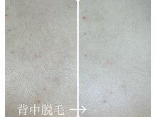 フォーチューン/背中脱毛♪