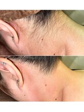 エースタイル(A-style.)/うなじ☆シュガーリング脱毛