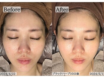 サロンドカメリア(salon de Camellia)/10日後のお肌が最強になります