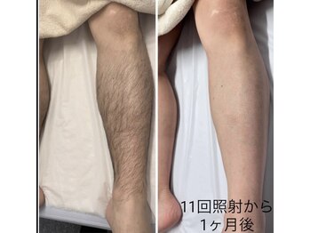 メリアミーゴ(Meli amigo)/【メンズ】足脱毛