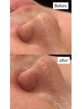 ラルガ 城野店(Raruga)/毛穴洗浄