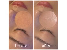 ブリス(BLiSS)の雰囲気（高濃度水素クレンジングで毛穴レスな素肌へ♪）