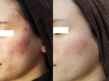 ハーブピーリングの種類と効果を徹底解説！肌質と目的に合わせた最適なご提案