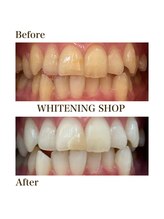 ホワイトニングショップ 安城店/【BeforeAfter】