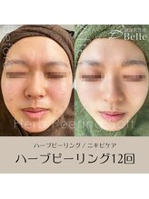 ベル 綱島(Belle)/ハーブピーリング【12回】