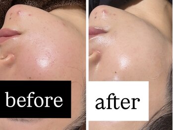 スールボーテ(soeur beaute)の写真/《黒ずみ・イチゴ鼻撃退に★》ララピールで毛穴ケア！韓国仕込みの技術で、つるんとした理想の美肌を実感♪