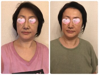 スイ(SUI)/夏前にスッキリ小顔に！