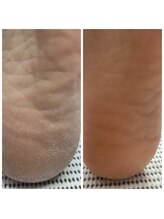 ドクターネイル爪革命 十条店/角質ケア