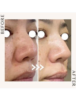 ハリーハリー 名古屋栄店(HARRY ハリー)/◆毛穴の黒ずみ・汚れ改善◆